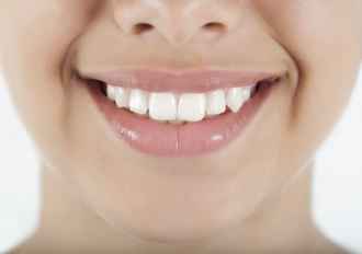Veneer -
